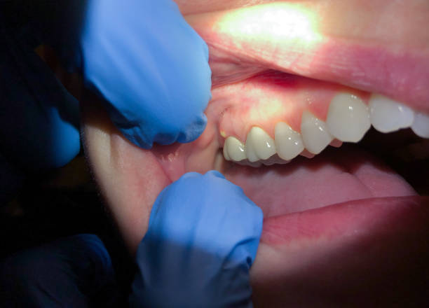 Best Emergency Gum Treatment in Senatobia, MS