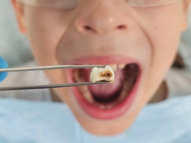 Best Emergency Tooth Extraction in Senatobia, MS